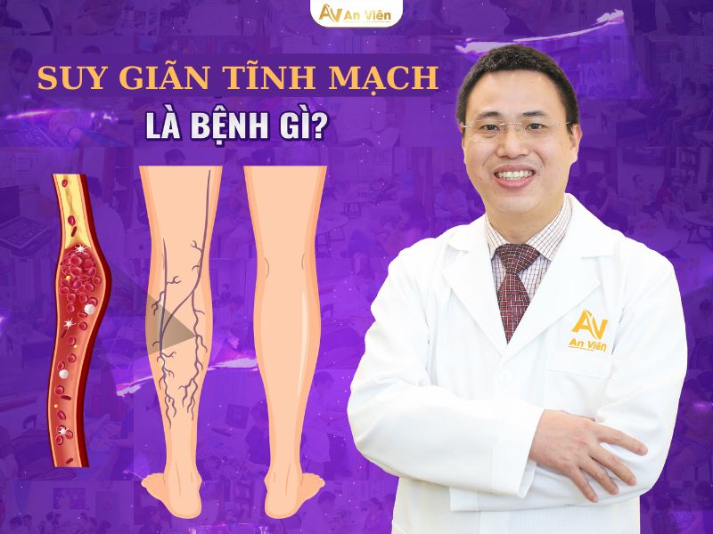 bị giãn tĩnh mạch có sao không