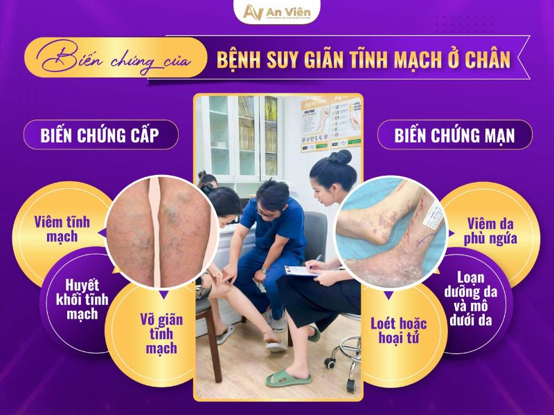 bị giãn tĩnh mạch có sao không