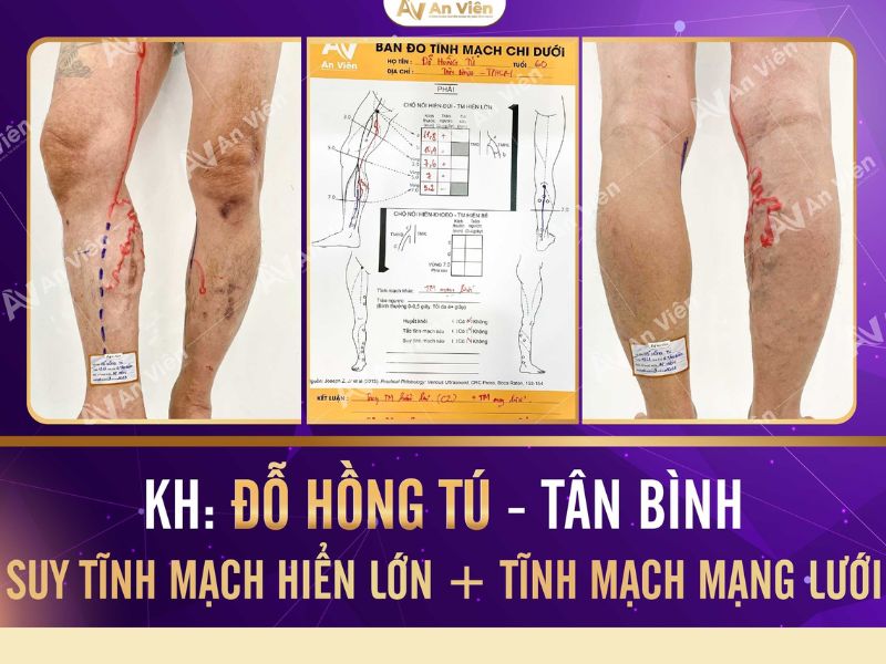 cách chữa giãn tĩnh mạch ở chân