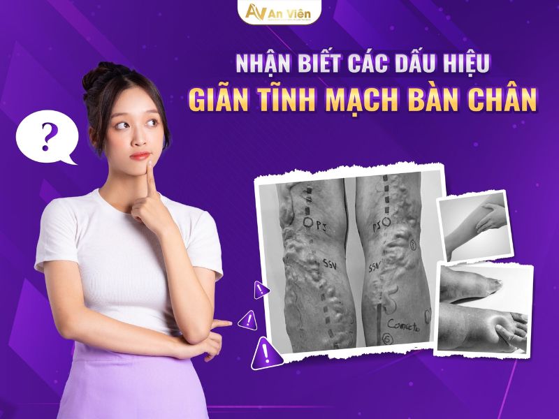 cách điều trị bệnh giãn tĩnh mạch
