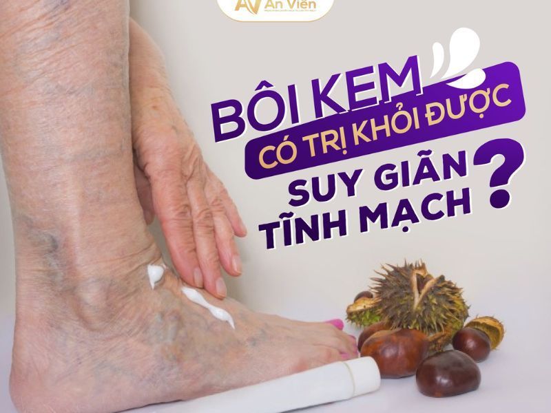 cách trị suy giãn tĩnh mạch ở chân