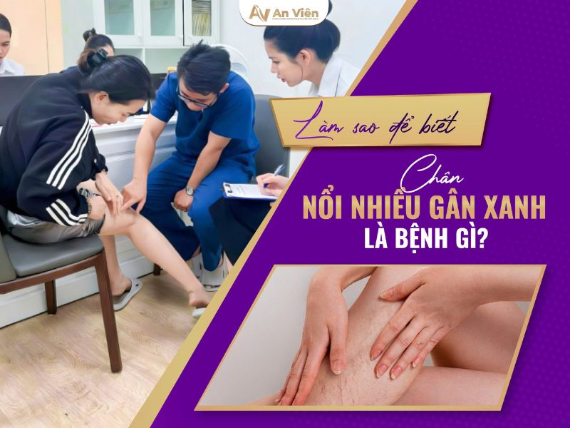 chân bị nổi gân xanh phải làm sao