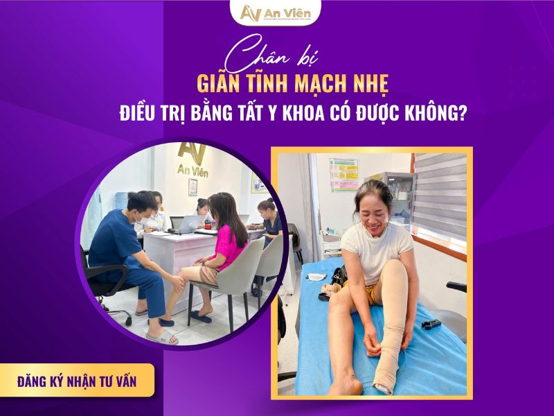 chân bị nổi gân xanh phải làm sao
