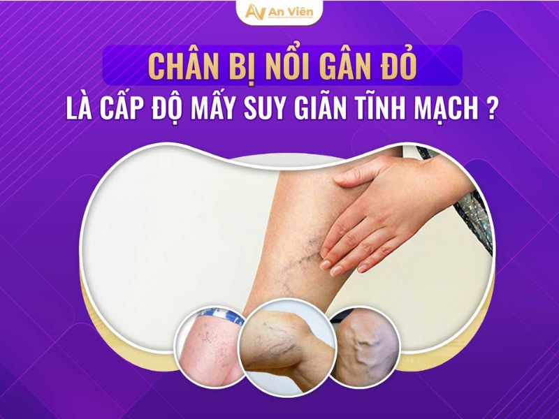 dấu hiệu chân bị giãn tĩnh mạch