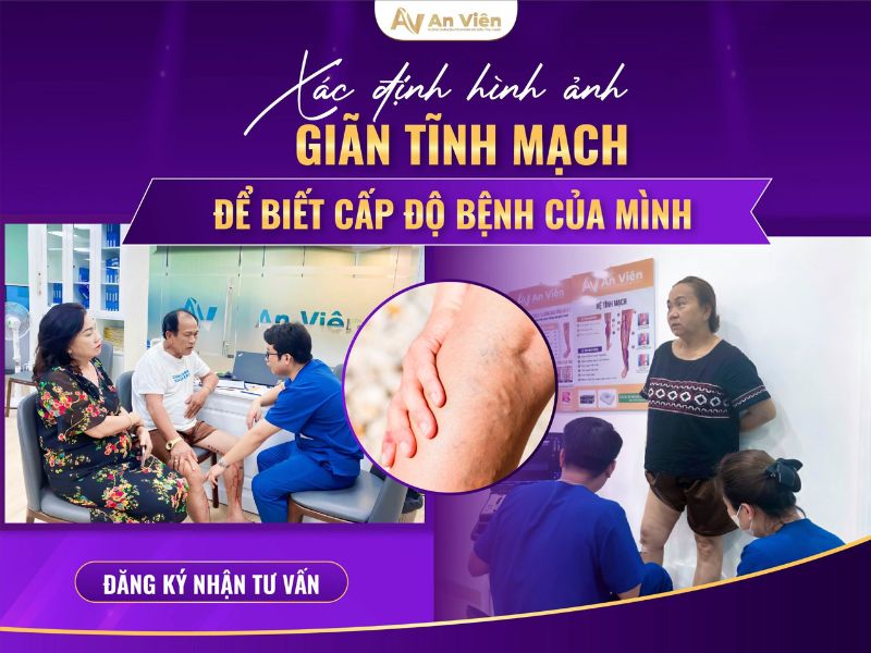 dấu hiệu chân bị giãn tĩnh mạch