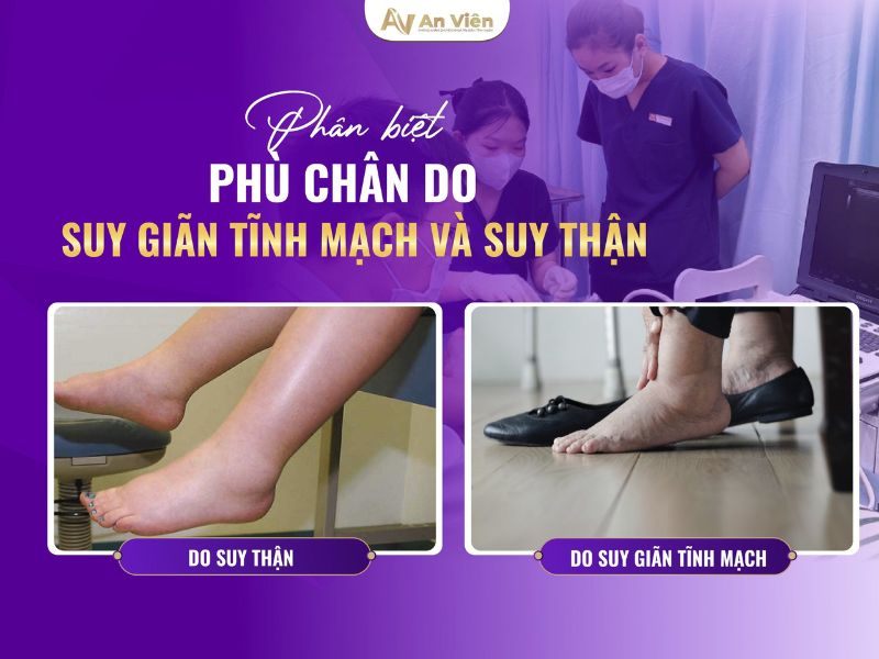 dấu hiệu chân bị giãn tĩnh mạch