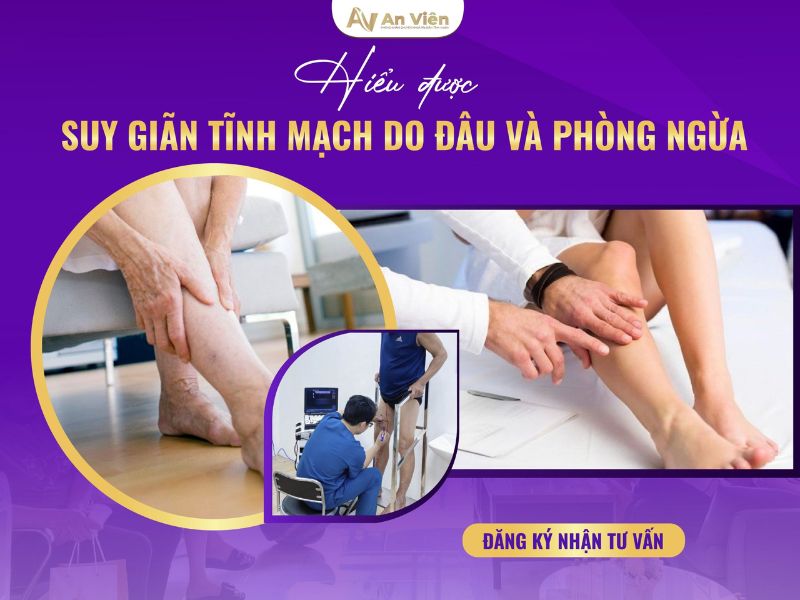 dấu hiệu chân bị giãn tĩnh mạch