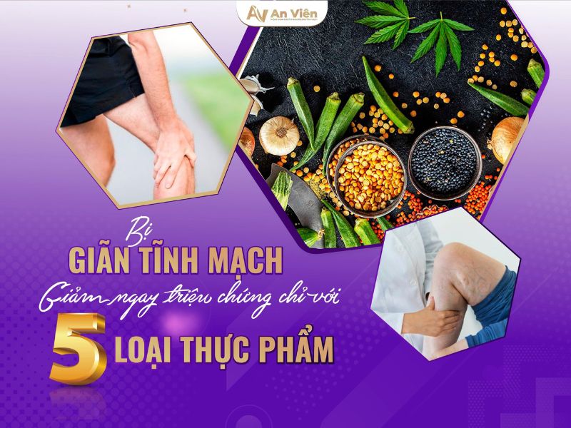 giãn tĩnh mạch chân kiêng gì