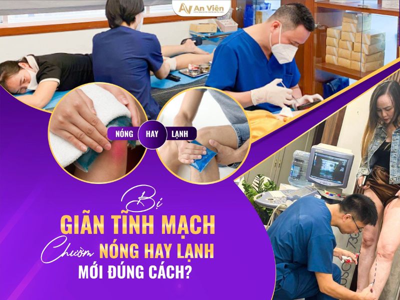 giãn tĩnh mạch chân kiêng gì