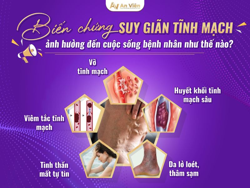 triệu chứng bị giãn tĩnh mạch chân