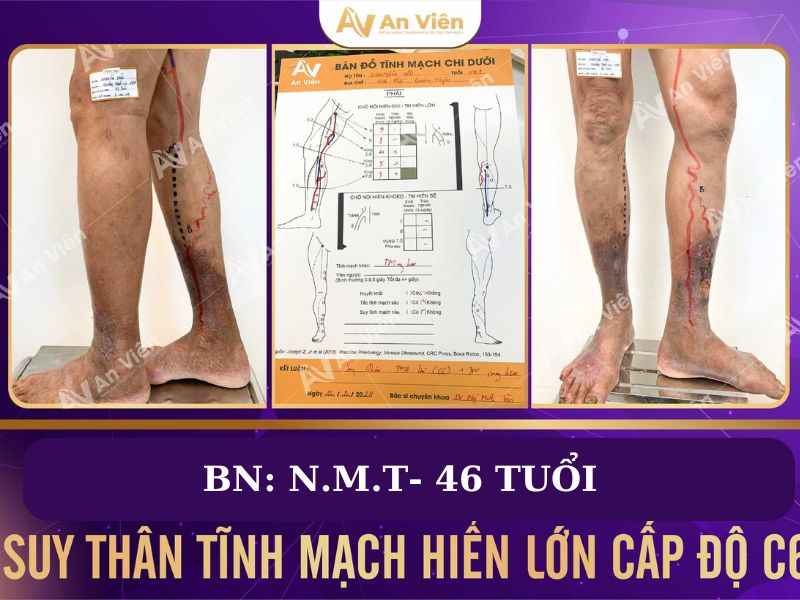 triệu chứng bị giãn tĩnh mạch chân