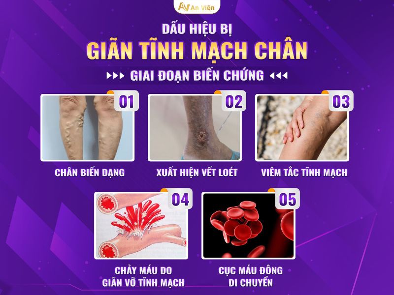 bệnh suy van tĩnh mạch sâu chi dưới