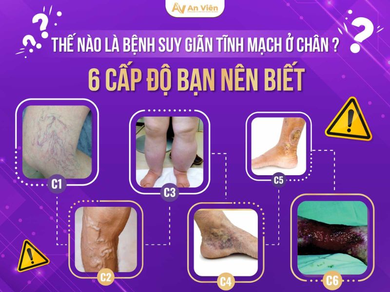 biểu hiện bệnh giãn tĩnh mạch chân