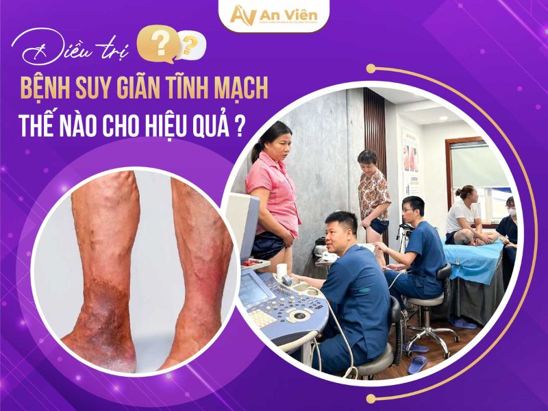 biểu hiện bệnh giãn tĩnh mạch chân