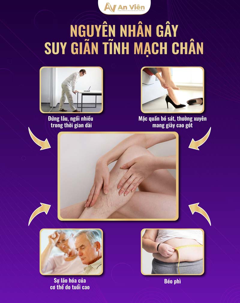 biểu hiện bệnh giãn tĩnh mạch chân