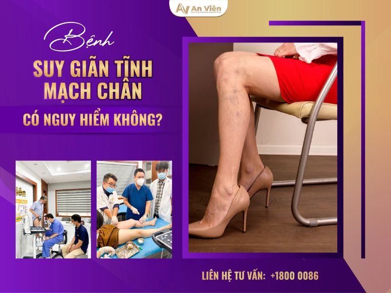 cách phòng chống giãn tĩnh mạch
