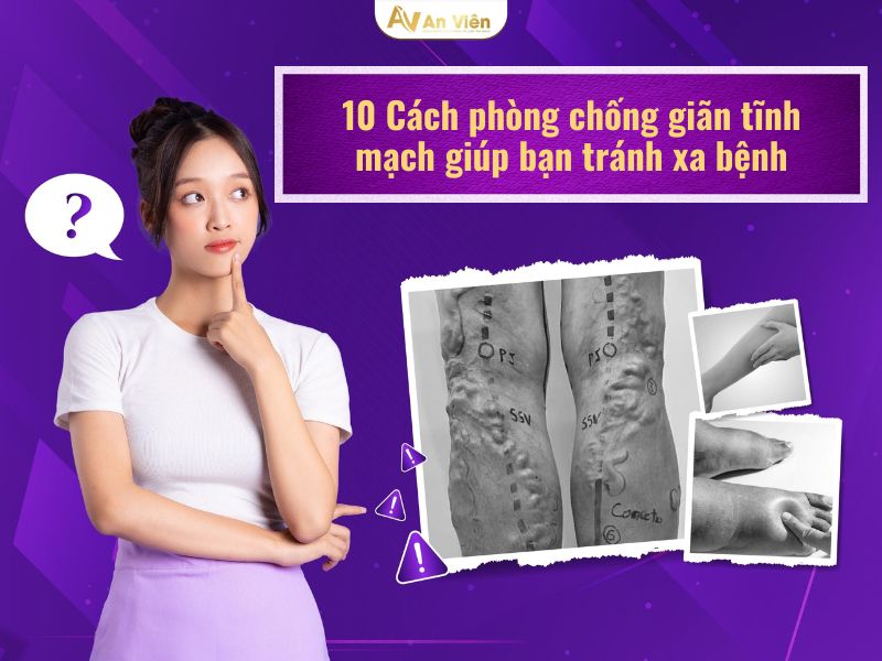 cách phòng chống giãn tĩnh mạch
