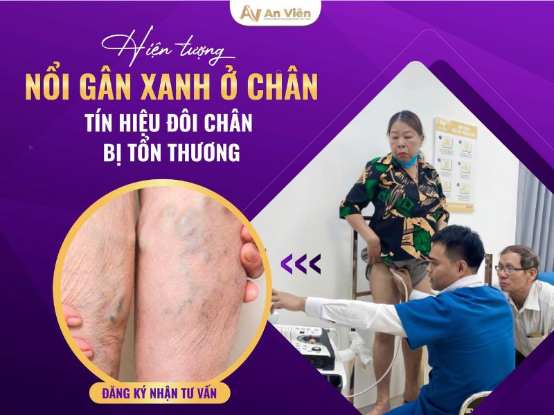 dấu hiệu của bệnh giãn tĩnh mạch