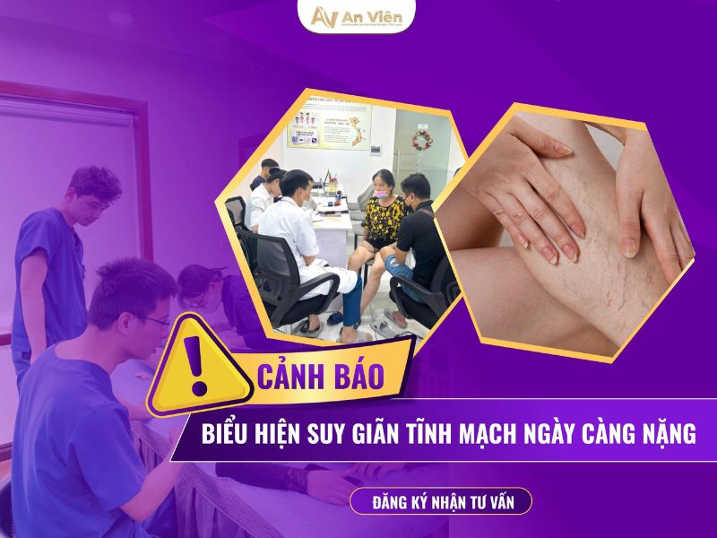 dấu hiệu của bệnh giãn tĩnh mạch
