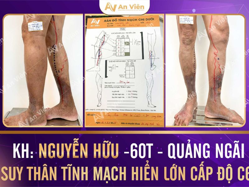 dấu hiệu của bệnh giãn tĩnh mạch