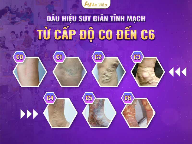 dấu hiệu giãn tĩnh mạch bàn chân