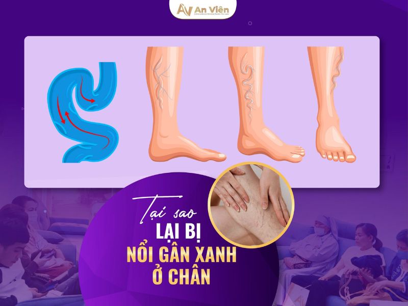 dấu hiệu giãn tĩnh mạch bàn chân