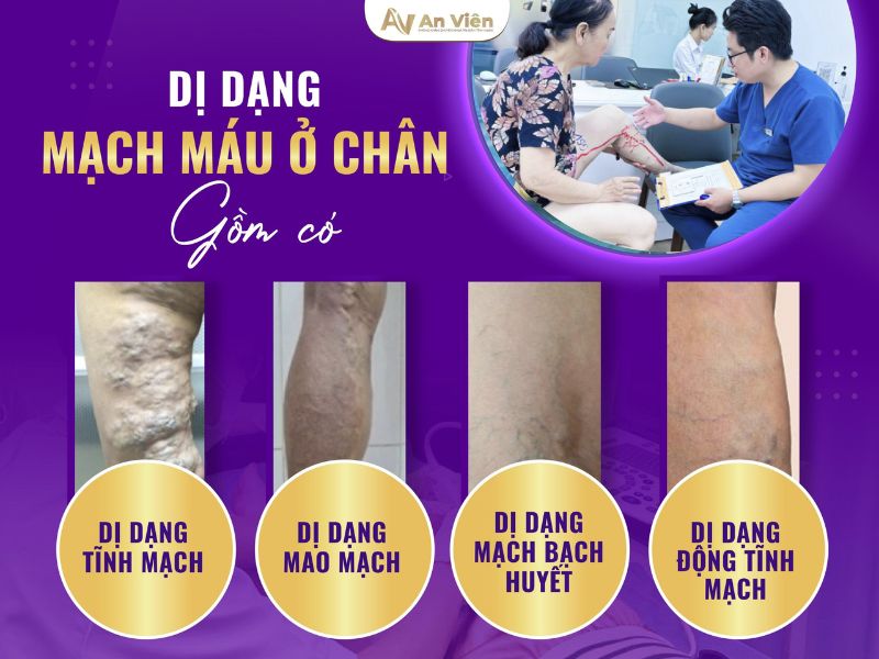 dị dạng mạch máu ở chân
