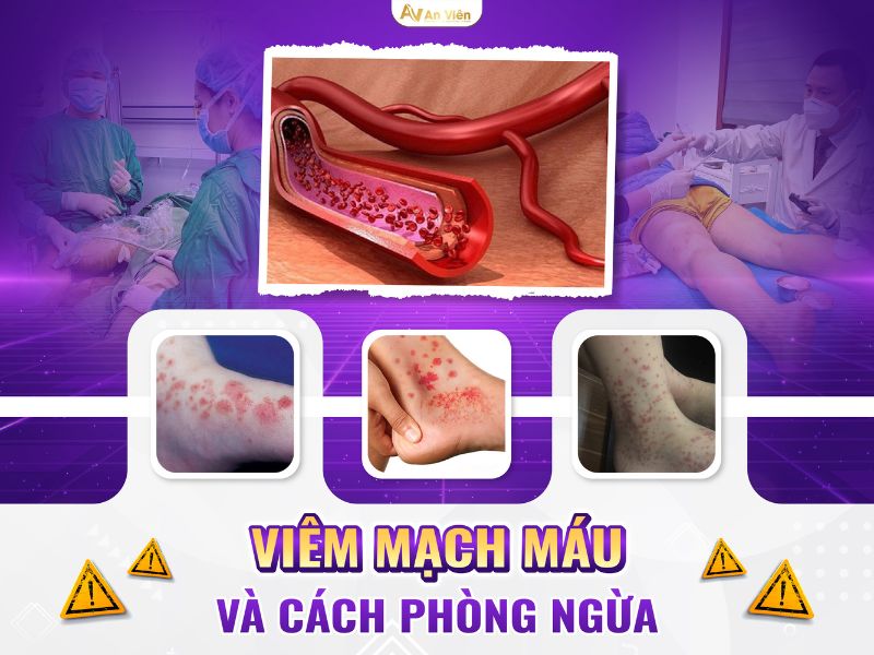 dị dạng mạch máu ở chân