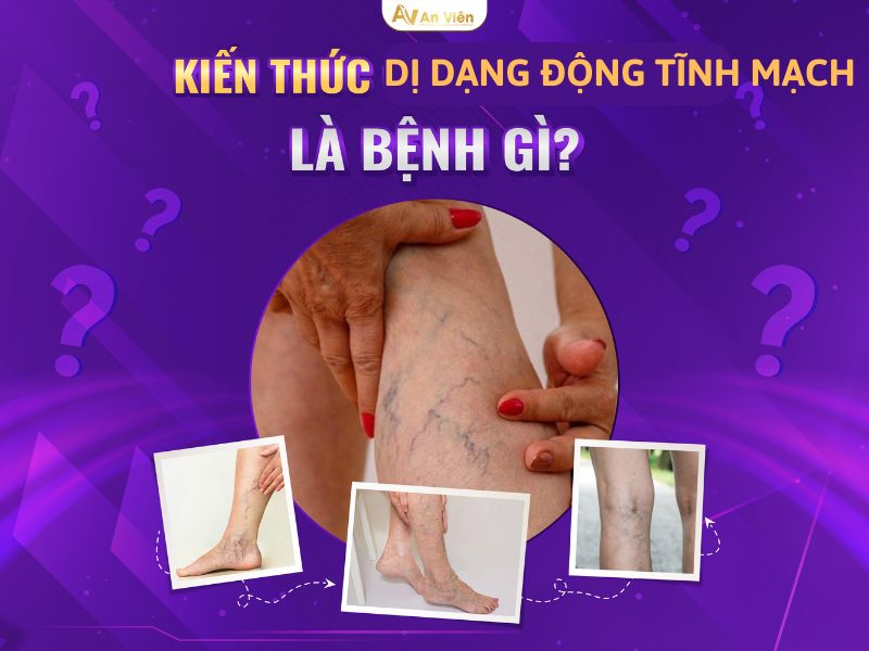 dị dạng mạch máu ở chân