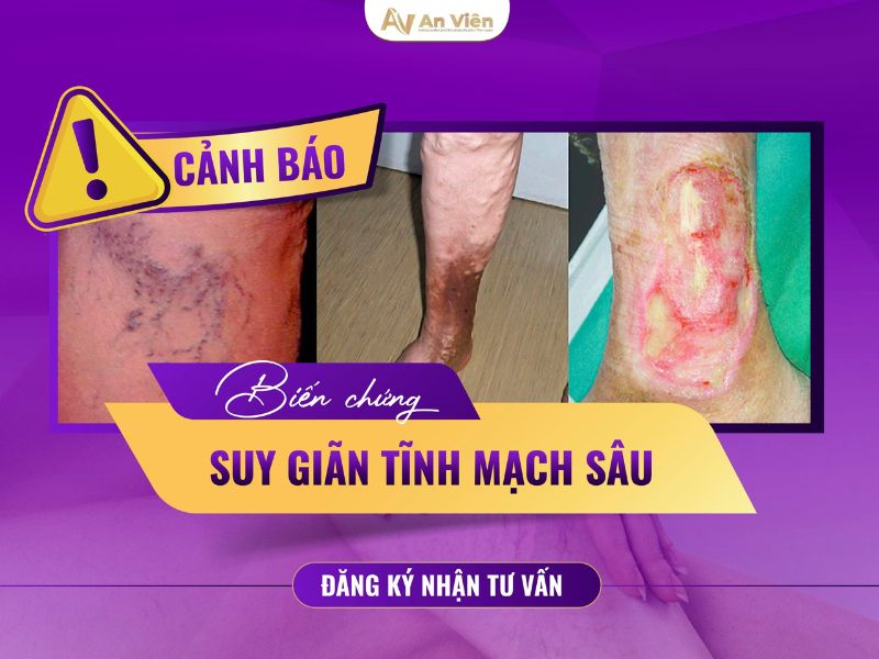 dị dạng mạch máu ở chân
