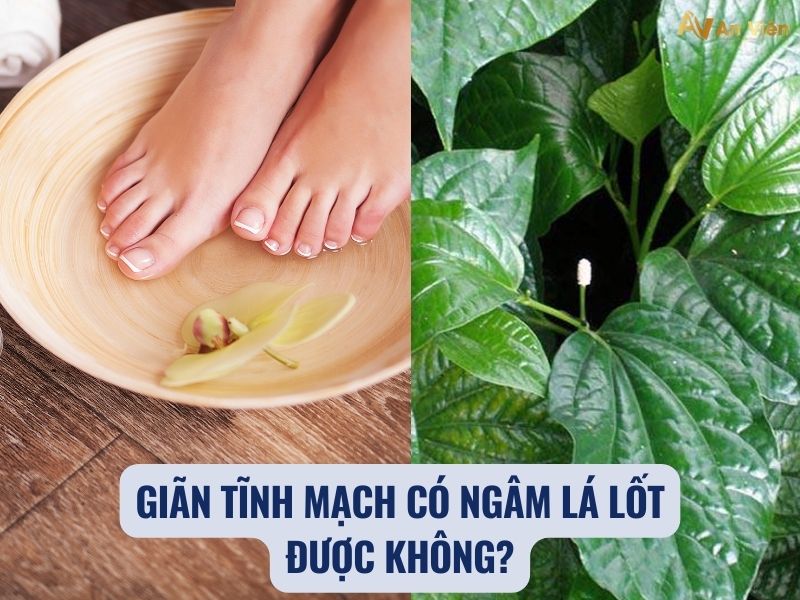 giãn tĩnh mạch chân có ngâm nước nóng được không