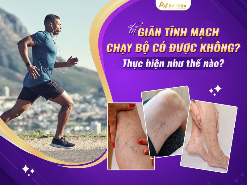 suy giãn tĩnh mạch có đi bộ được không