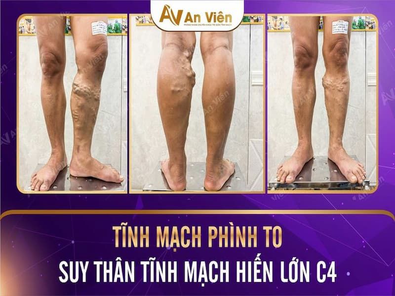suy giãn tĩnh mạch có đi bộ được không