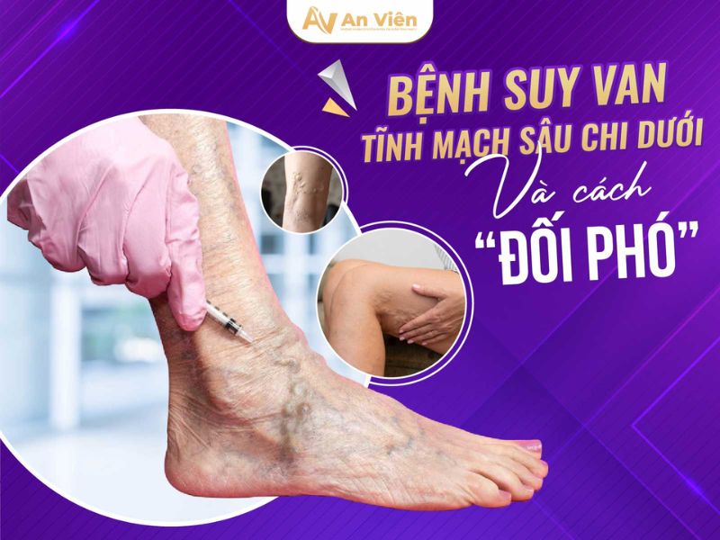 suy van tĩnh mạch sâu chi dưới hai bên