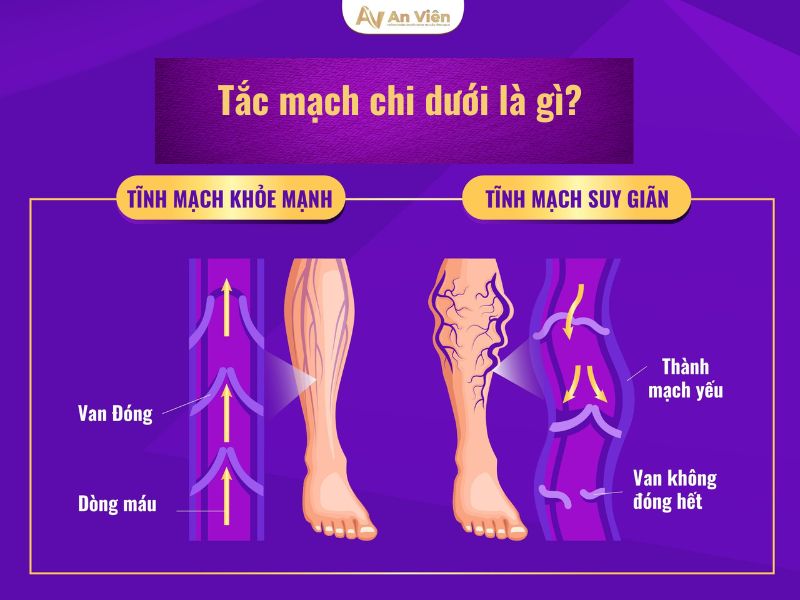 tắc mạch chi dưới
