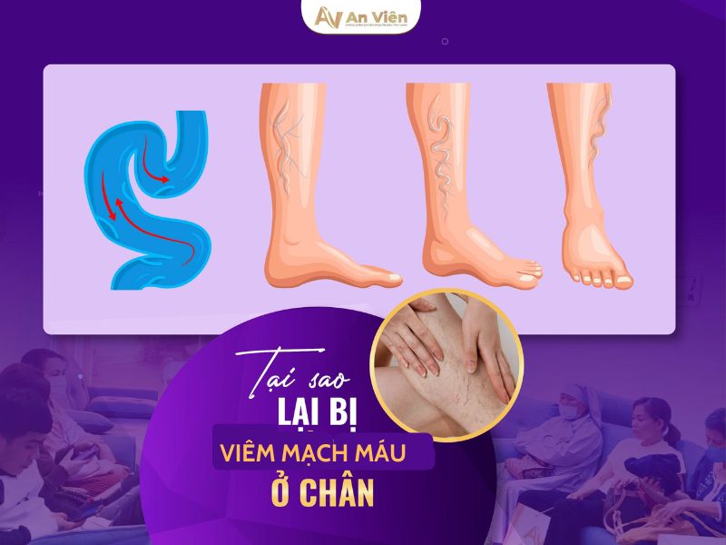 viêm mạch máu ở chân
