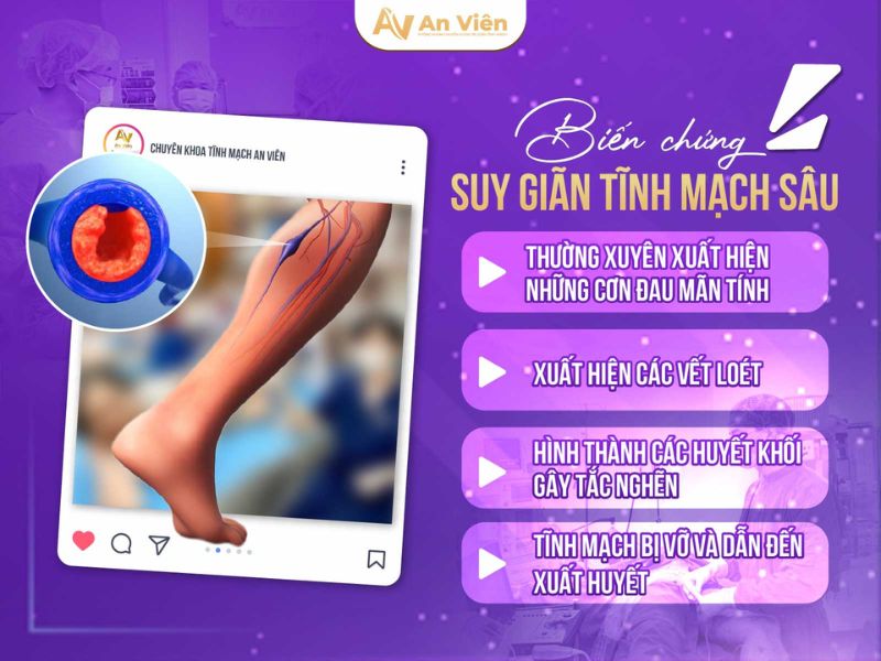 biểu hiện của giãn tĩnh mạch chân