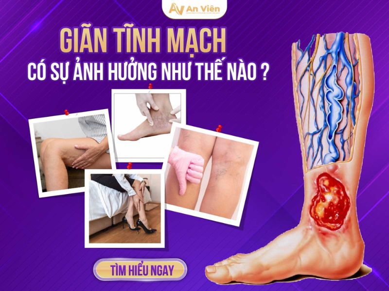 biểu hiện của giãn tĩnh mạch chân
