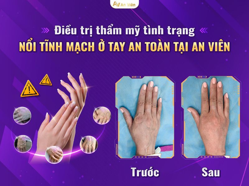 nguyên nhân giãn tĩnh mạch tay