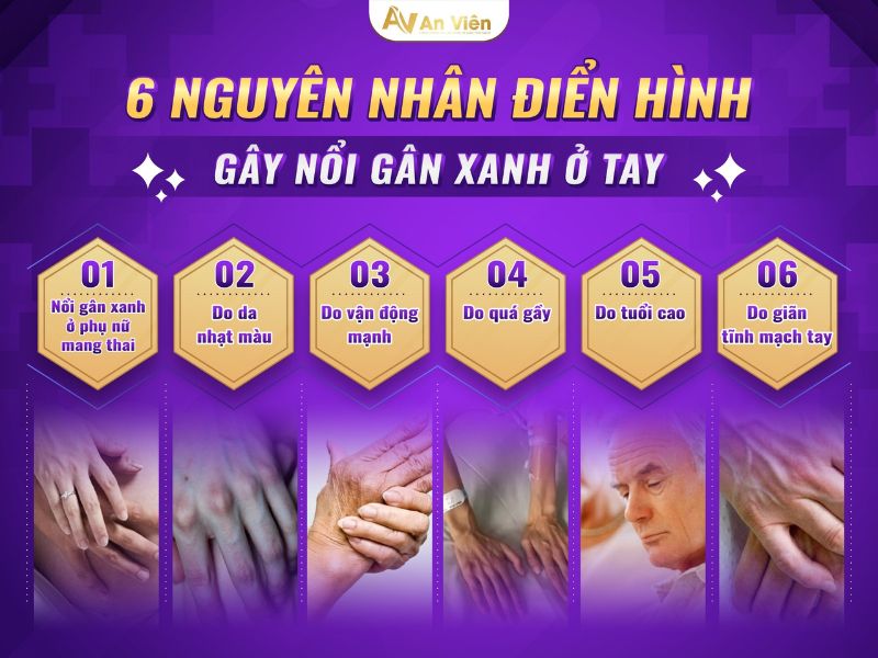 nguyên nhân giãn tĩnh mạch tay