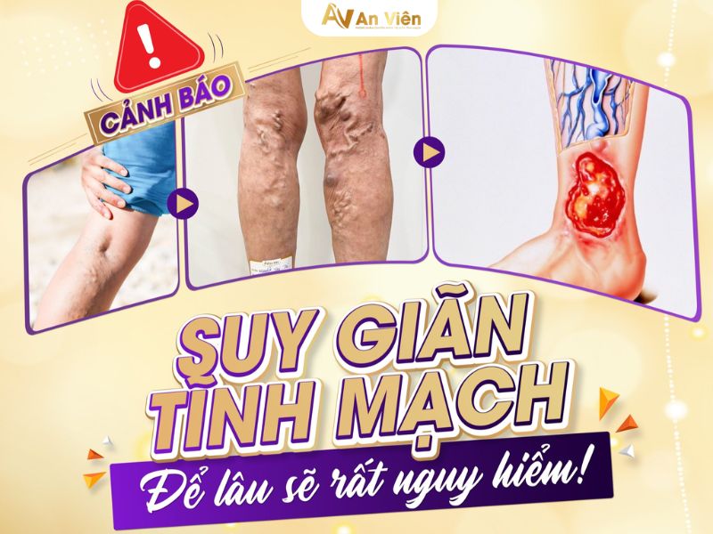 nguyên nhân suy tĩnh mạch