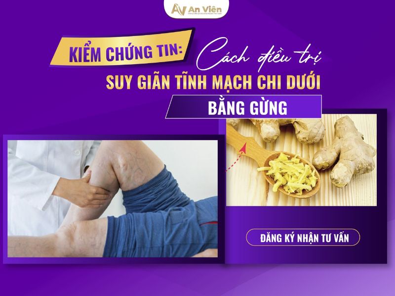 nổi tĩnh mạch chân