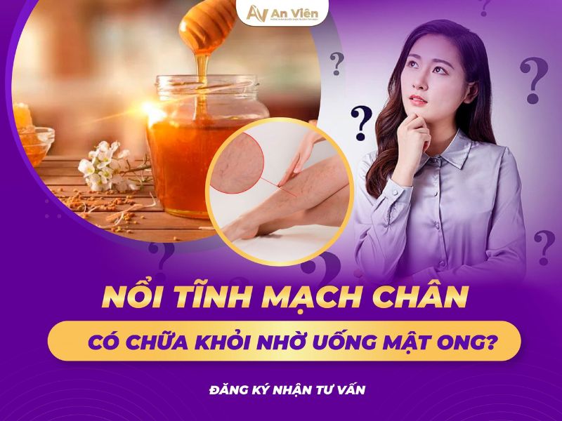 nổi tĩnh mạch chân