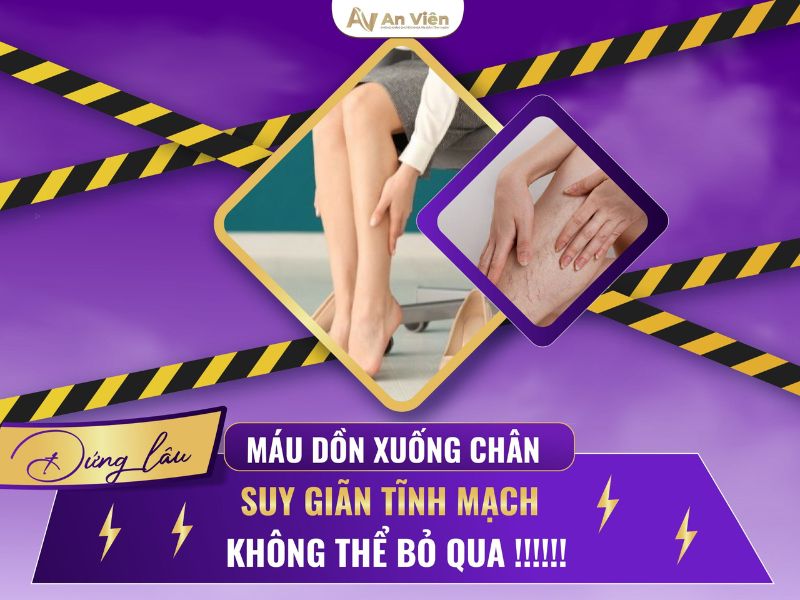 tác hại của giãn tĩnh mạch