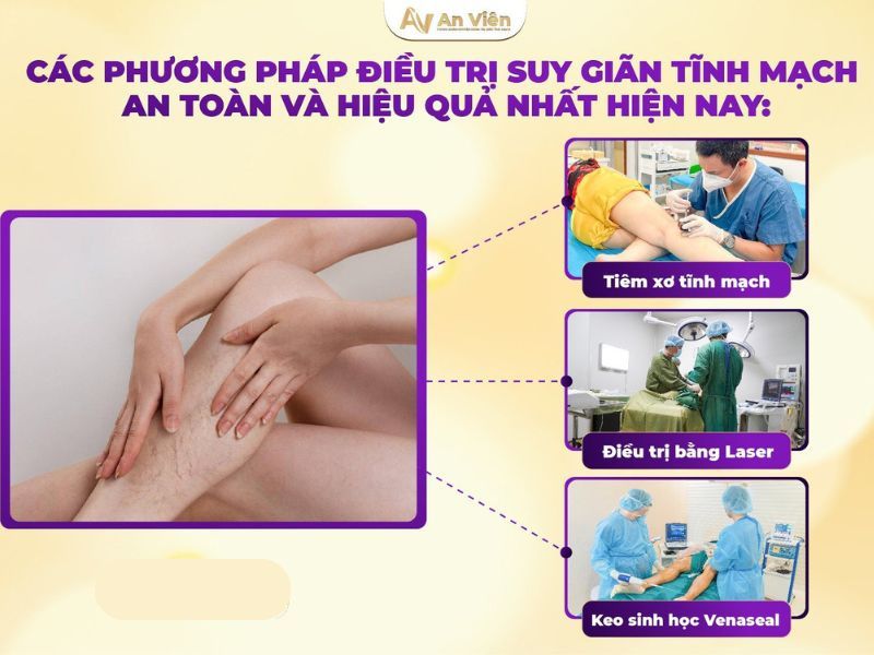 tại sao bị giãn tĩnh mạch chân