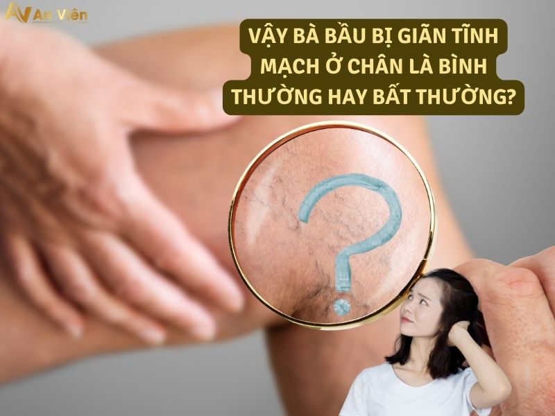 bà bầu bị giãn tĩnh mạch ở chân