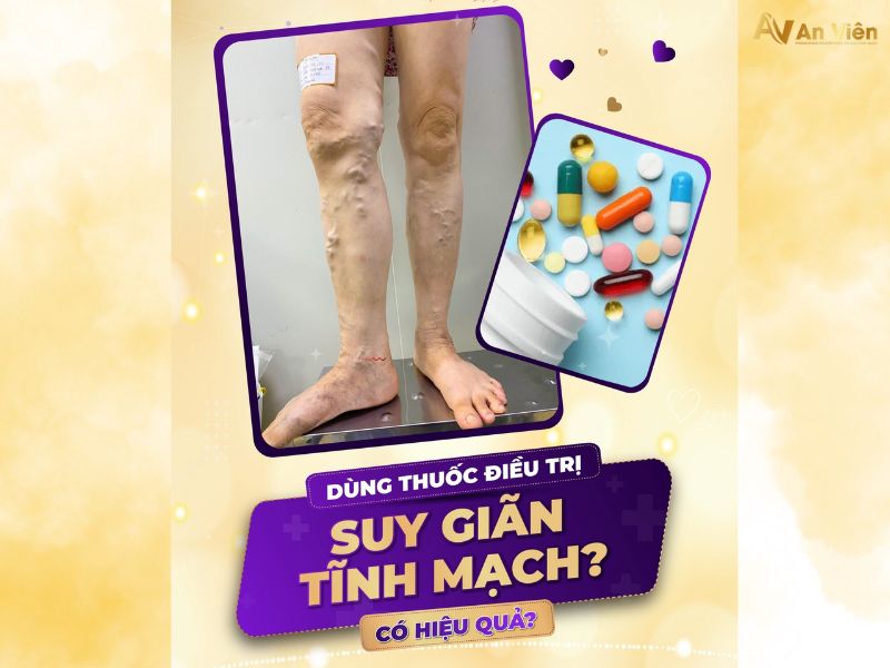 bệnh tĩnh mạch chân