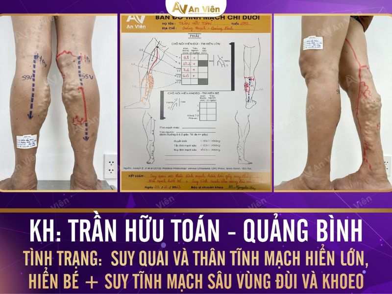 biểu hiện suy giãn tĩnh mạch 
