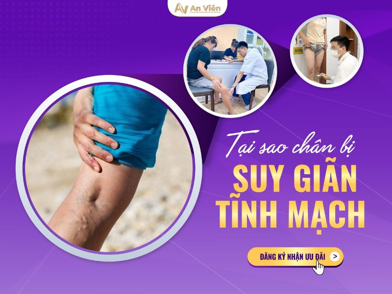 biểu hiện suy giãn tĩnh mạch 