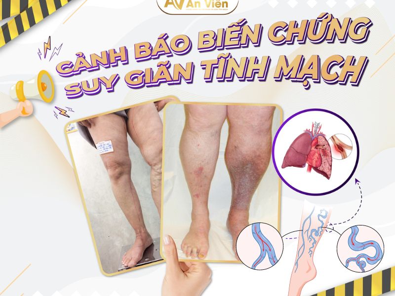 biểu hiện suy giãn tĩnh mạch 